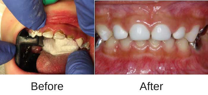 Before and after look of Baby Bottle Tooth Decay